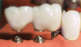 Zahn-implantat Zahnarzt Weinheim